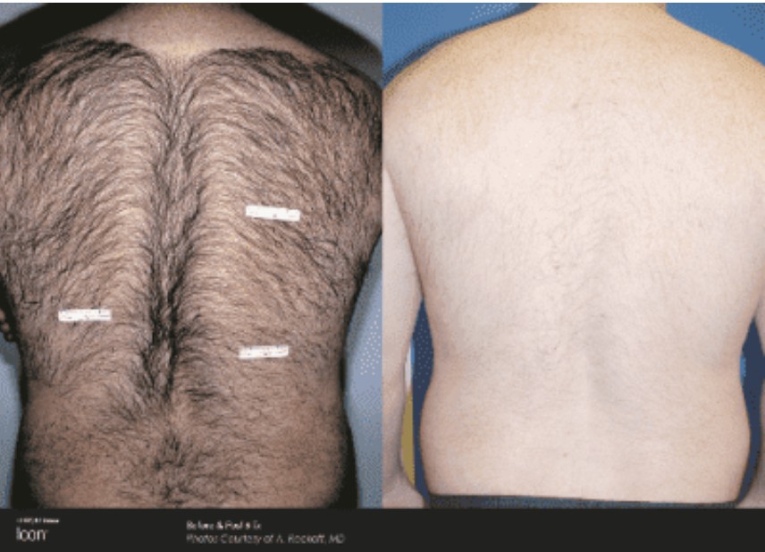 Icon Laser: Laser Hair Removal Gallery