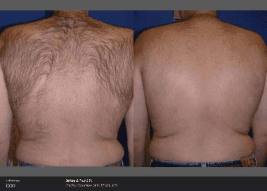 Icon Laser: Laser Hair Removal Gallery