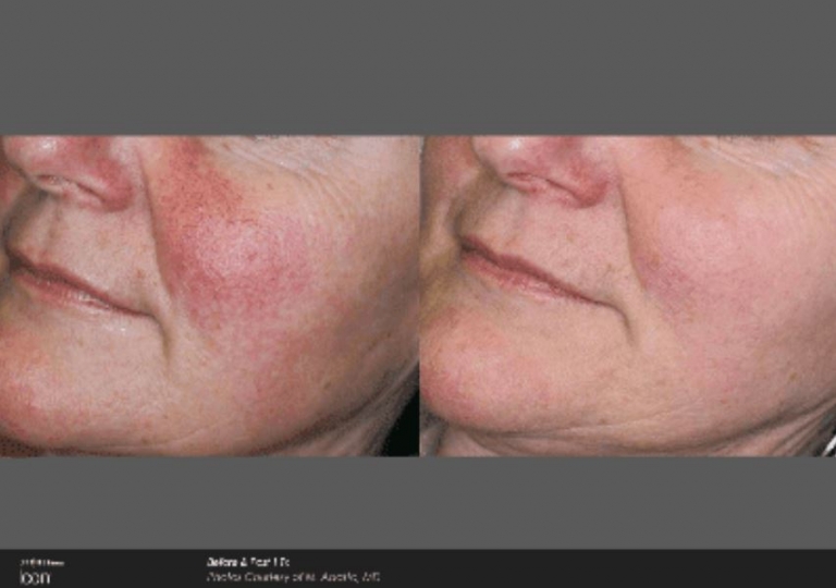 Icon Laser: Skin Rejuvenation Gallery