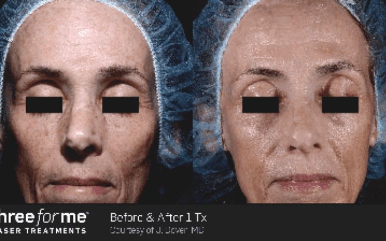 Icon Laser: ThreeForMe Gallery