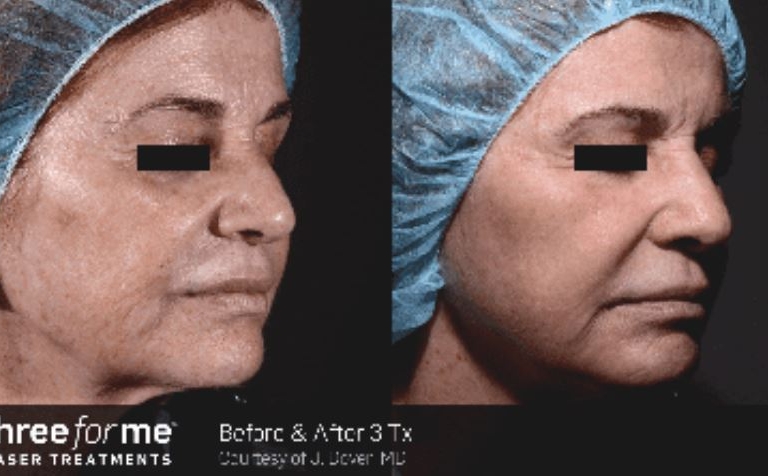 Icon Laser: ThreeForMe Gallery