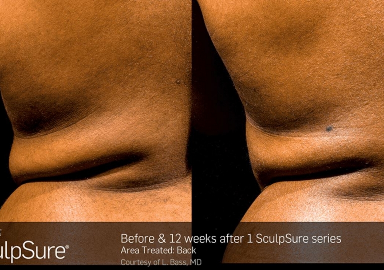 SculpSure Gallery